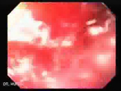 Severe Variceal Bleeding - 49 Years-Old Alcoholic Male