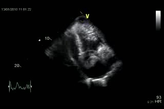 Cardiac Tamponade