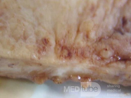 Small Gastric Adenocarcinoma of the Diffuse Ring Cell (14 of 19)