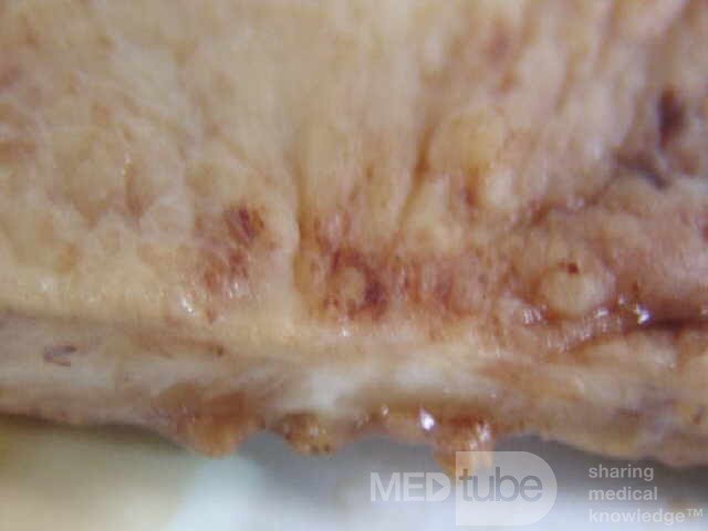 Small Gastric Adenocarcinoma of the Diffuse Ring Cell (14 of 19)