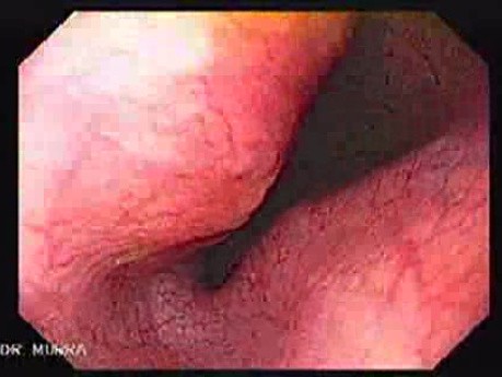 Gastrointestinal Stromal Tumors - Closer Look at the Tumor