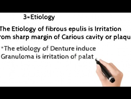 Fibrous Epulis, Fibrous Polyp, Denture Induce Granuloma 