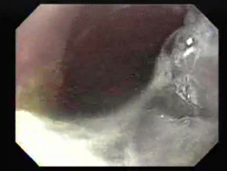 Achalasia - residual food (4 of 11)
