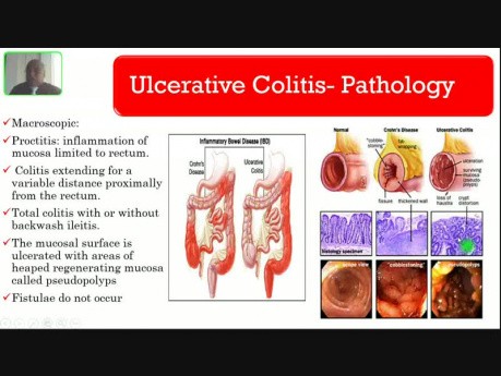 Inflammatory Bowel Disease - Lower GI Hemorrhage
