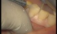 Upper Arch Teeth Preparation And Provisional Crowns (1/5)