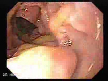 Gastroduodenal MALT lymphoma (7 of 9)