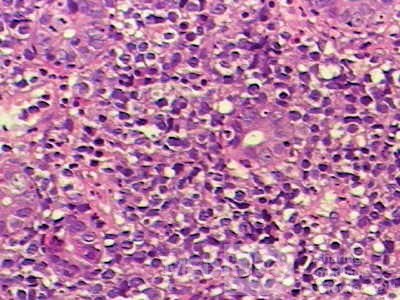 Non-Hodgkin's Lymphoma of the Colon (14 of 16)