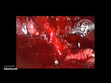 Laparoscopic Cholecystectomy in Acute Cholecystitis