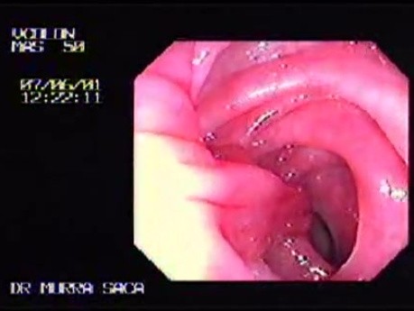 Bilobulated, Pediculated Villotubular Adenoma (2 of 2)