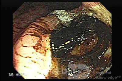Gastric Cancer - Assessment of Very Deep Ulcer, Part 1
