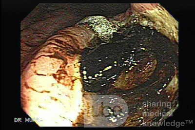 Gastric Cancer - Assessment of Very Deep Ulcer, Part 1