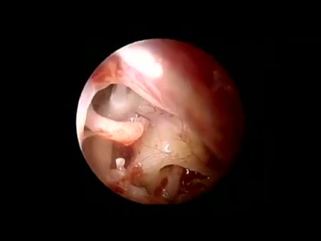 Otosclerosis Endoscopic Stapedotomy