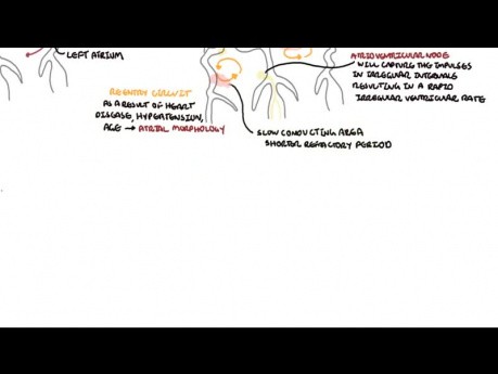 Atrial Fibrillation Overview - ECG, Types, Pathophysiology, Treatment, Complications