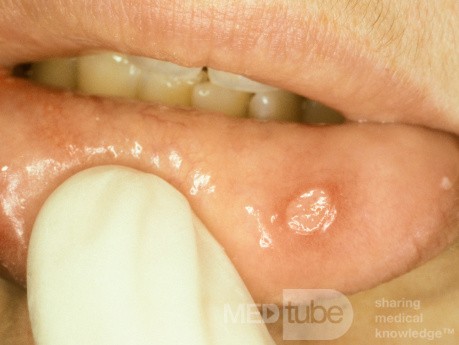 Apthous Ulcer Lip