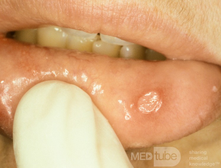 Apthous Ulcer Lip