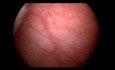 Luts Cystoscopy 