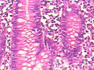 Non-Hodgkin's Lymphoma of the Colon (11 of 16)