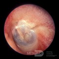 Temporal Bone Fracture [left ear]