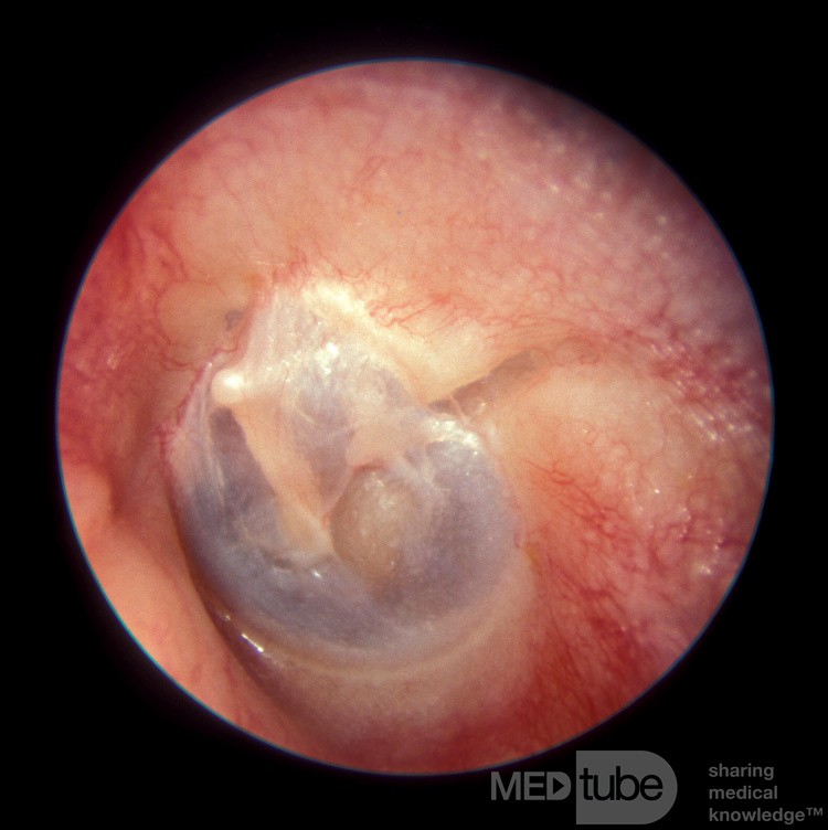 Temporal Bone Fracture [left ear]
