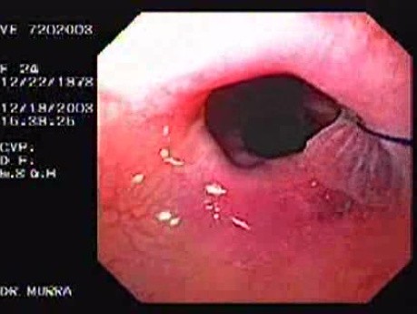 Flexible Endoscopic Suturing - Traction