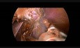 Laparoscopic Resection of Splenic Cyst