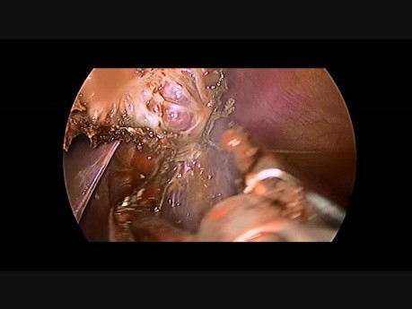 Laparoscopic Resection of Splenic Cyst