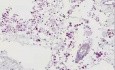 Cryptococcosis (PAS stain)