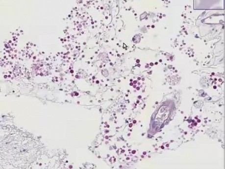 Cryptococcosis (PAS stain)