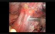 Anatomic S1 Segmentectomy by means of Uniportal VATS