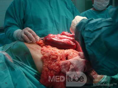 Mesenteric Ischemia (9 of 12)