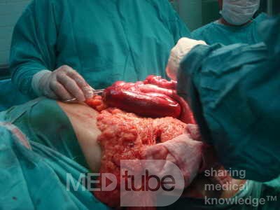 Mesenteric Ischemia (9 of 12)