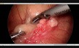 Laparoscopic Left Adrenalectomy