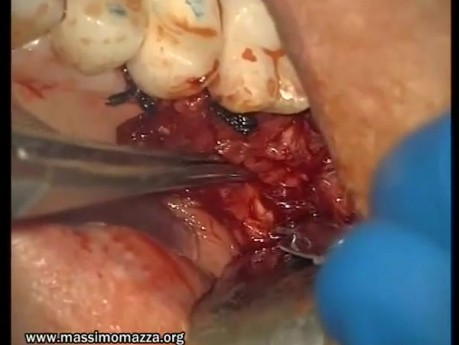 Reconstruction Of Adhesive Gingiva (4/5)
