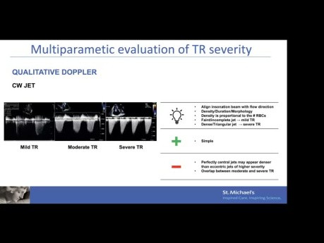 Echo Assessment of Tricuspid Regurgitation – Mechanism, Quantification and Device Selection