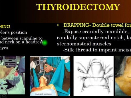 Thyroidectomy - Operative Surgery