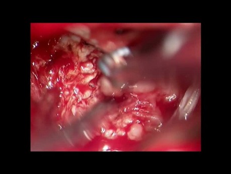 Intra Extrameatal Acoustic Neuroma