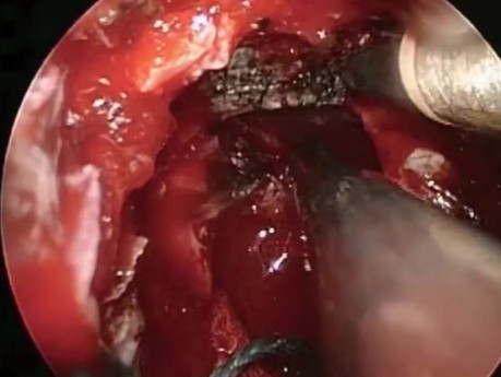 Endoscopic Removal of Pituitary Tumor 