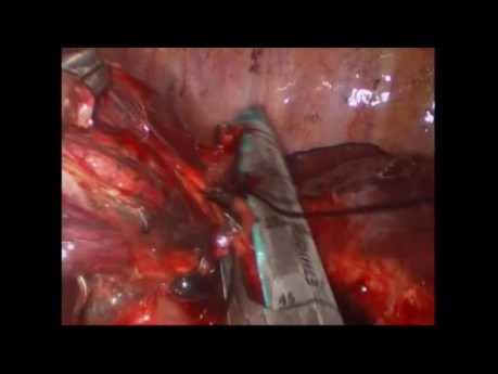 Uniportal VATS Left Upper Anatomic Segmentectomy S2+S4-5