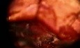 Brain tumor Surgery Footage