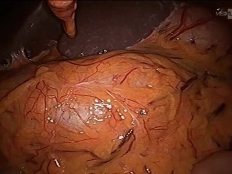Laparoscopic Right Colectomy with CME Vascular Control