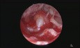 Cholesteatoma Ear Endoscopic Surgery