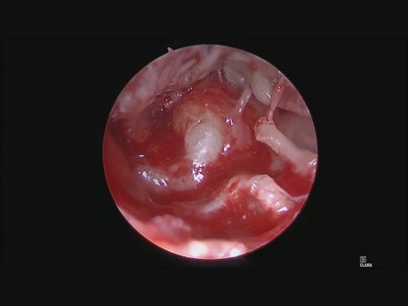 Cholesteatoma Ear Endoscopic Surgery
