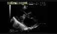 Infective Endocarditis: Vegetation On Both Mitral Leaflets With Involvement Of Aortic Cusps