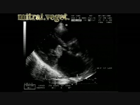 Infective Endocarditis: Vegetation On Both Mitral Leaflets With Involvement Of Aortic Cusps