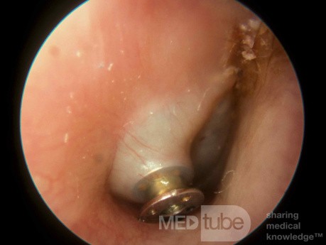 Acute Otitis Media Pushing Tube Out of Drum