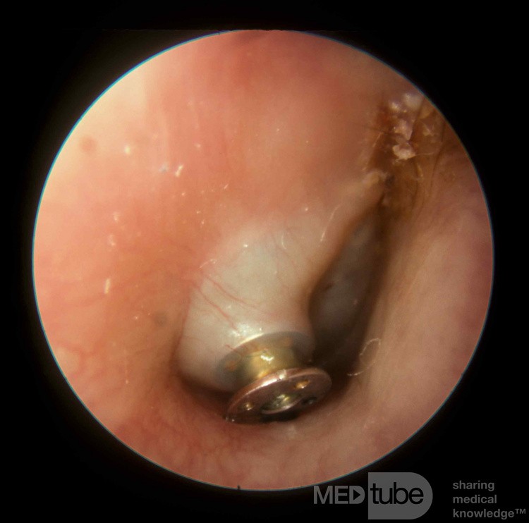 Acute Otitis Media Pushing Tube Out of Drum