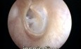 Roving anterosuperoior segment movement of the left eardrum