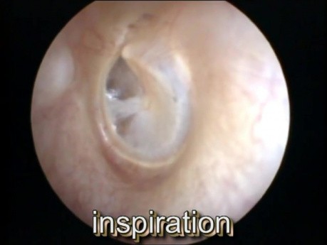Roving anterosuperoior segment movement of the left eardrum