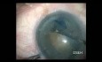 Hard Cataract