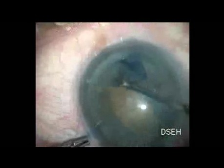Hard Cataract
